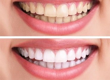Tooth-whitening